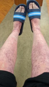 My legs and feet with amoxicillin rash while waiting at the ER